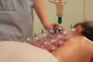 Cupping Therapy
